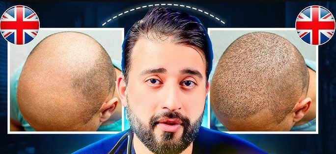 The best hair transplant clinics in London and UK